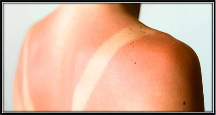 Can health care cream help with sunburn and sun damage?